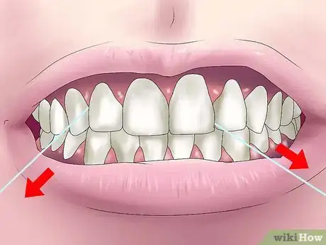 Imagen titulada Fix Crooked Teeth Step 28