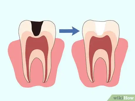 Imagen titulada Cure a Toothache Step 7