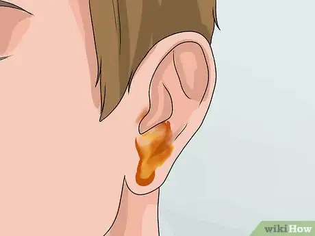 Imagen titulada Know if You Have Otitis Media Step 3