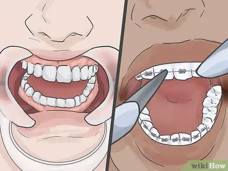 Imagen titulada Heal Cracks in the Corners of Your Mouth Step 12