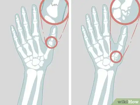 Imagen titulada Diagnose a Broken Thumb Step 10