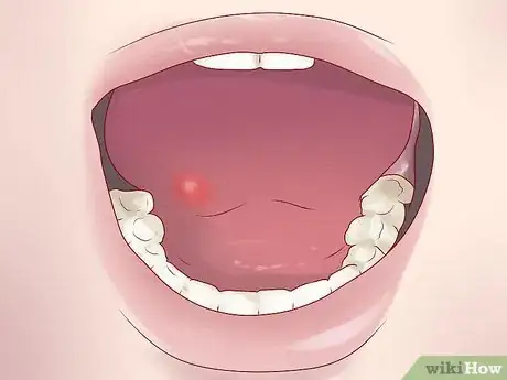 Imagen titulada Tell if You Have Mouth Cancer Step 2