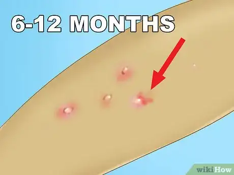 Imagen titulada Recognize Molluscum (Molluscum Contagiosum) Step 9