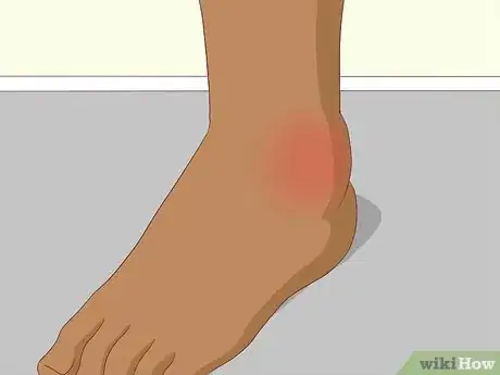 Imagen titulada Recognize Gout Symptoms Step 4