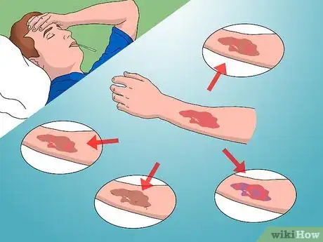 Imagen titulada Treat Electrical Burns Step 10