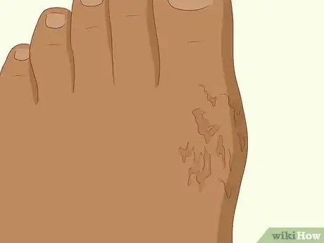 Imagen titulada Recognize Gout Symptoms Step 6