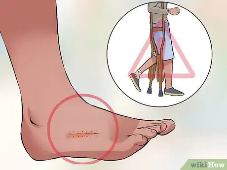 Imagen titulada Remove Stitches Step 13