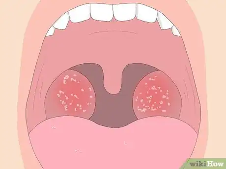 Imagen titulada Tell if You Have Strep Throat Step 7