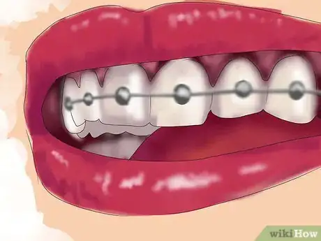 Imagen titulada Fix Crooked Teeth Step 7