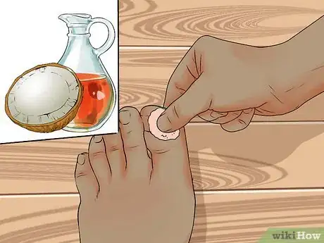 Imagen titulada Avoid Ingrown Toenails Step 10