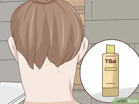 Imagen titulada Get Rid of Dandruff at Home Step 4