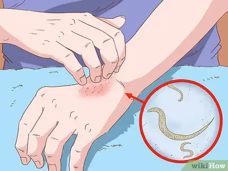 Imagen titulada Recognize and Prevent a Pinworm Infection Step 4