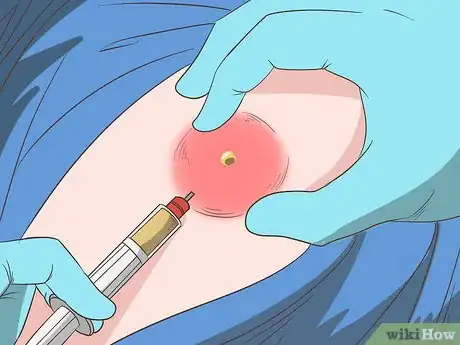 Imagen titulada Get Rid of an Abscess Step 11