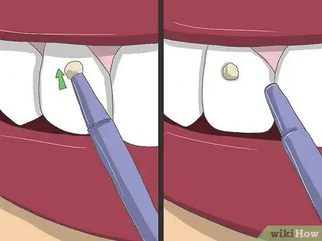 Imagen titulada Apply Tooth Gems Step 11