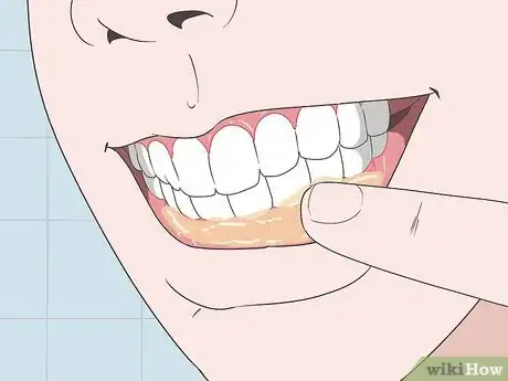 Imagen titulada Treat a Gum Infection Step 6