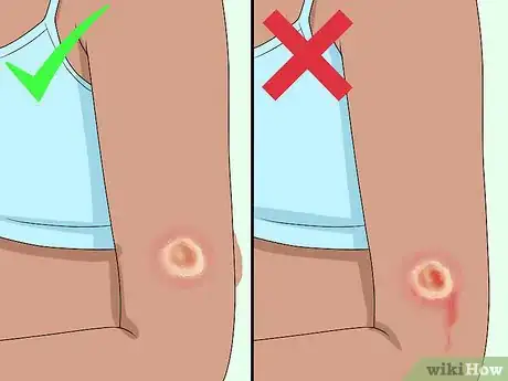 Imagen titulada Get Rid of a Scab Step 1