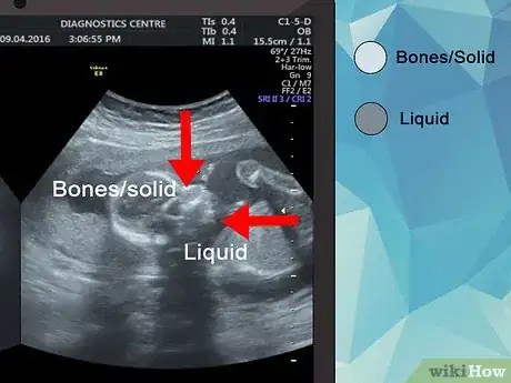 Imagen titulada Read an Ultrasound Picture Step 3