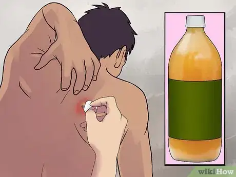 Imagen titulada Remove a Sebaceous Cyst Step 8