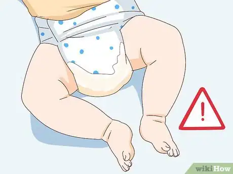 Imagen titulada Change a Disposable Bedwetting Diaper Step 1