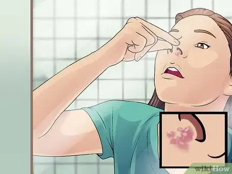 Imagen titulada Treat Cold Sores in Your Nose Step 1