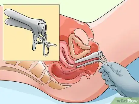 Imagen titulada Have a Gynecological Exam Step 18