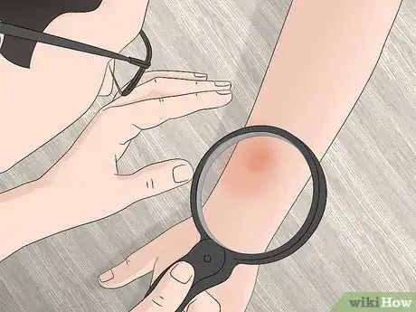 Imagen titulada Identify Tick Bites Step 10