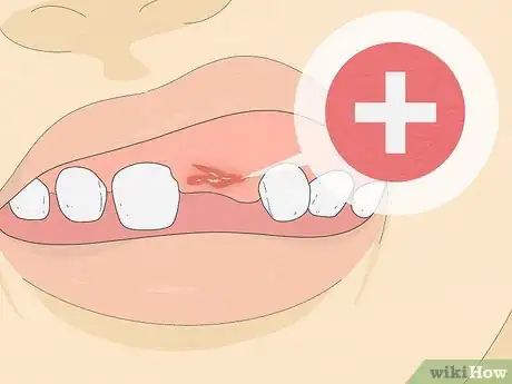 Imagen titulada Pull a Loose Tooth at Home Step 13