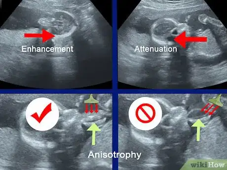 Imagen titulada Read an Ultrasound Picture Step 4