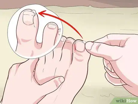 Imagen titulada Cut an Ingrown Toenail Step 10