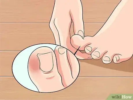 Imagen titulada Cure an Infected Toe Step 1