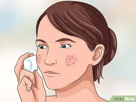 Imagen titulada Get Rid of Large Pores and Blemishes Step 2