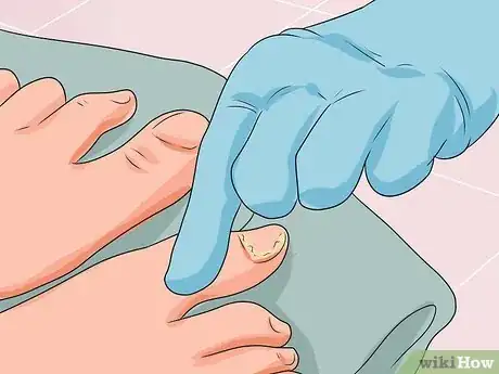 Imagen titulada Cure Nail Fungus Step 4