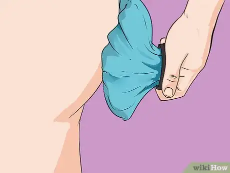 Imagen titulada Treat Hemorrhoids After Pregnancy Step 2