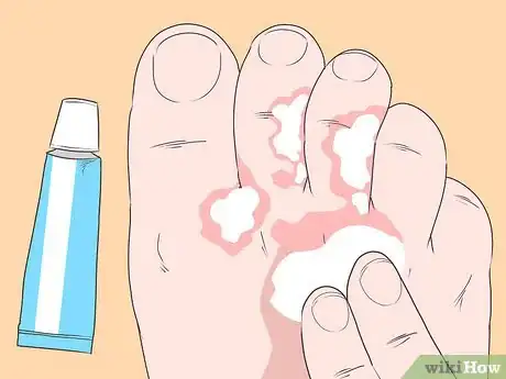 Imagen titulada Stop Itching Caused by Athlete's Foot Step 1