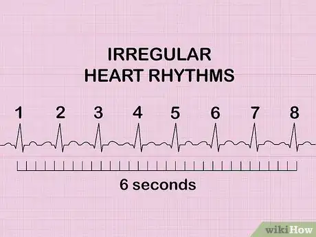 Imagen titulada Calculate Heart Rate from ECG Step 8
