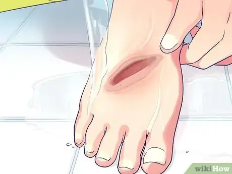 Imagen titulada Change a Wound Dressing Step 8