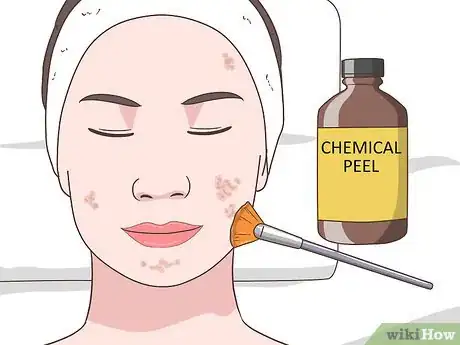 Imagen titulada Get Rid of Acne Cysts Fast Step 20
