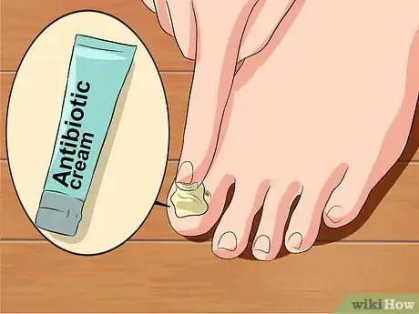 Imagen titulada Remove a Dead Toenail Step 15