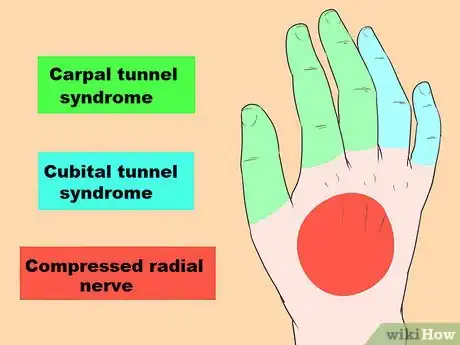 Imagen titulada Treat Numbness in Hands Step 5