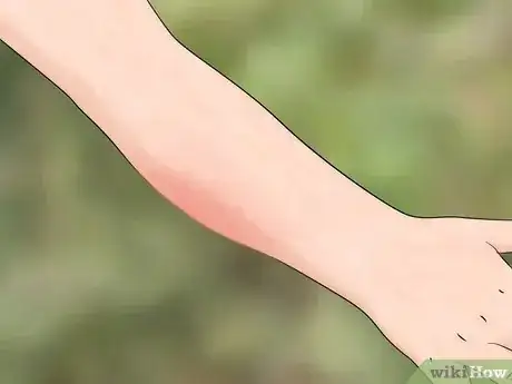 Imagen titulada Identify Insect Bites Step 3