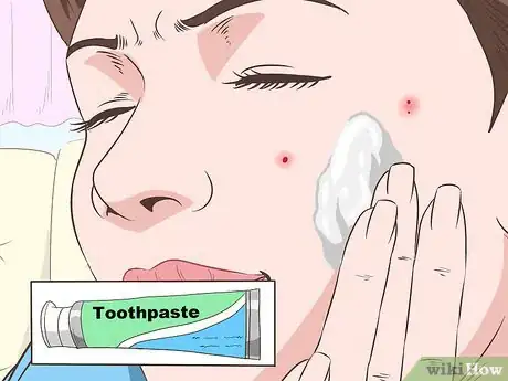 Imagen titulada Stop Mosquito Bites from Itching Step 10