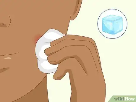 Imagen titulada Instantly Get Rid of a Pimple (Cotton Ball Popping Method) Step 8