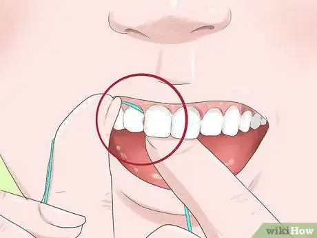 Imagen titulada Know if Your Dental Fillings Need Replacing Step 6