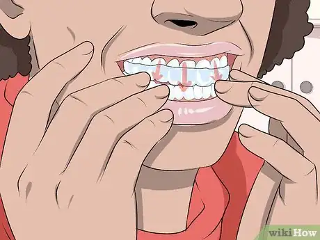 Imagen titulada Use Teeth Whitening Gel Step 7