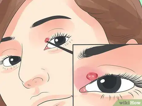 Imagen titulada Recognize an Eyelid Cyst Step 2