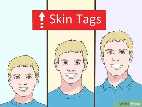 Imagen titulada Prevent Skin Tags Step 4