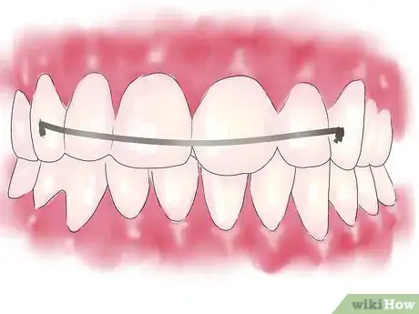 Imagen titulada Fix Crooked Teeth Step 5