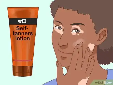 Imagen titulada Prevent Vitiligo Step 11