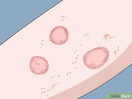 Imagen titulada Diagnose a Yeast Infection at Home Step 5