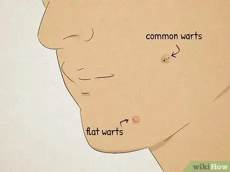 Imagen titulada Remove Facial Warts Step 6